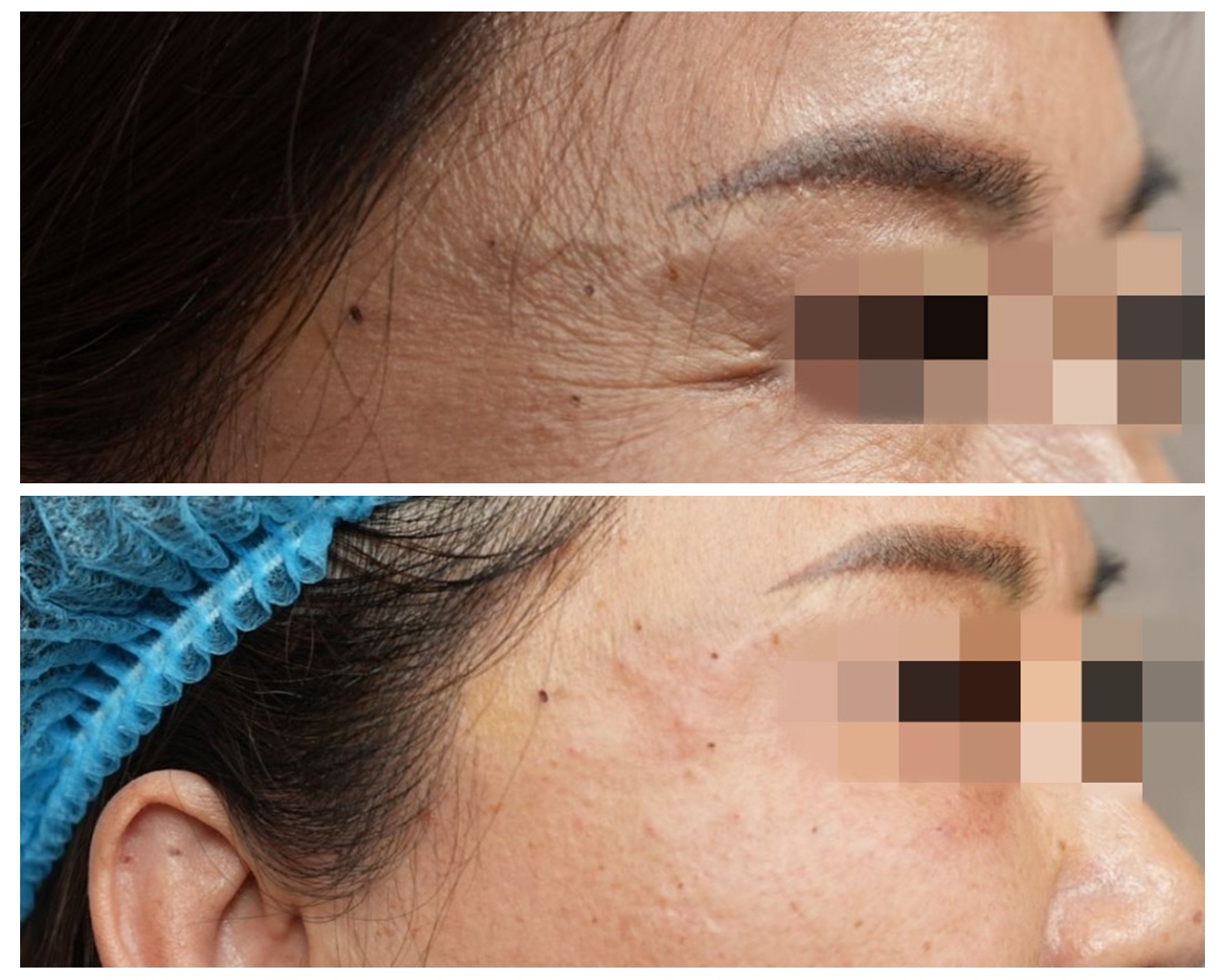 botulinum toxin before and after pics