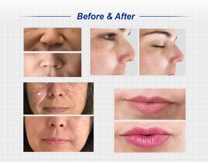 needleless lip filler price