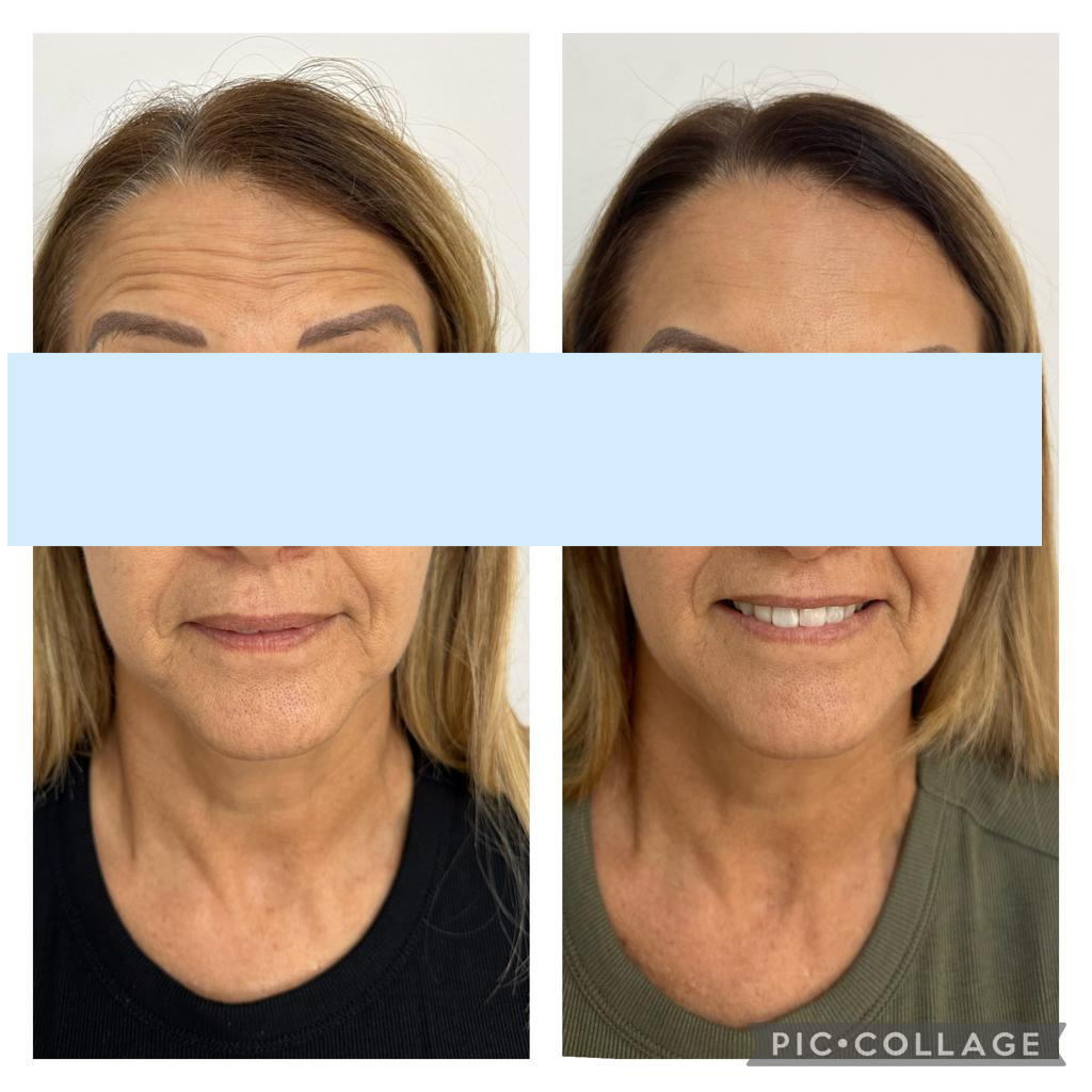 botulinum toxin before and after pics