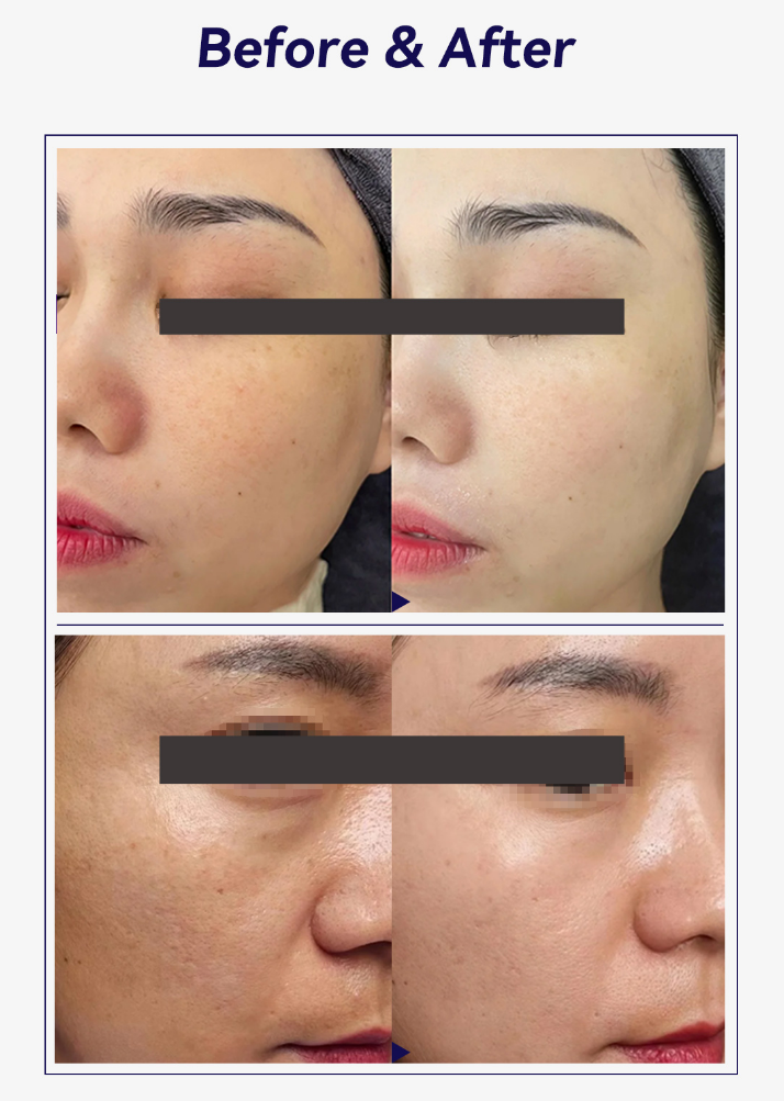 collagen face injections before and after photos