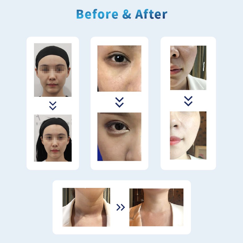 Poly L Lactic Acid Injection before after - Dermax