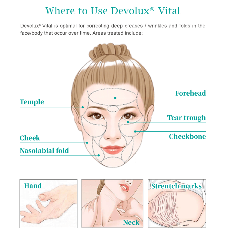 Devolux vital Poly L Lactic Acid dermal filler treatment areas - Dermax