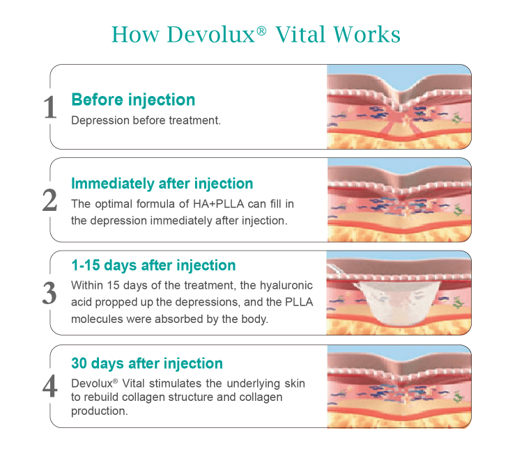 Poly L Lactic Acid Injection work - Dermax