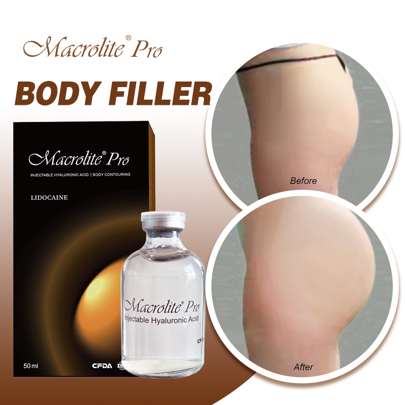 Macrolite® Pro Body Filler 50ml Before & After