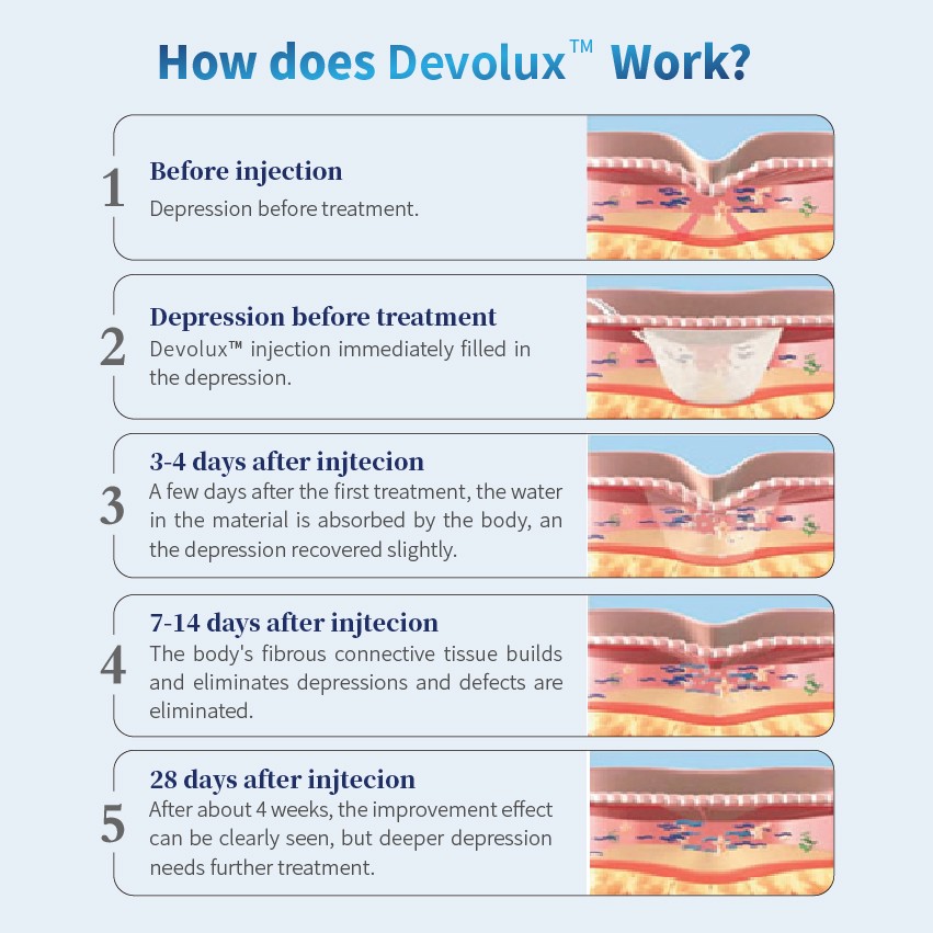 Poly L Lactic Acid Injection work - Dermax