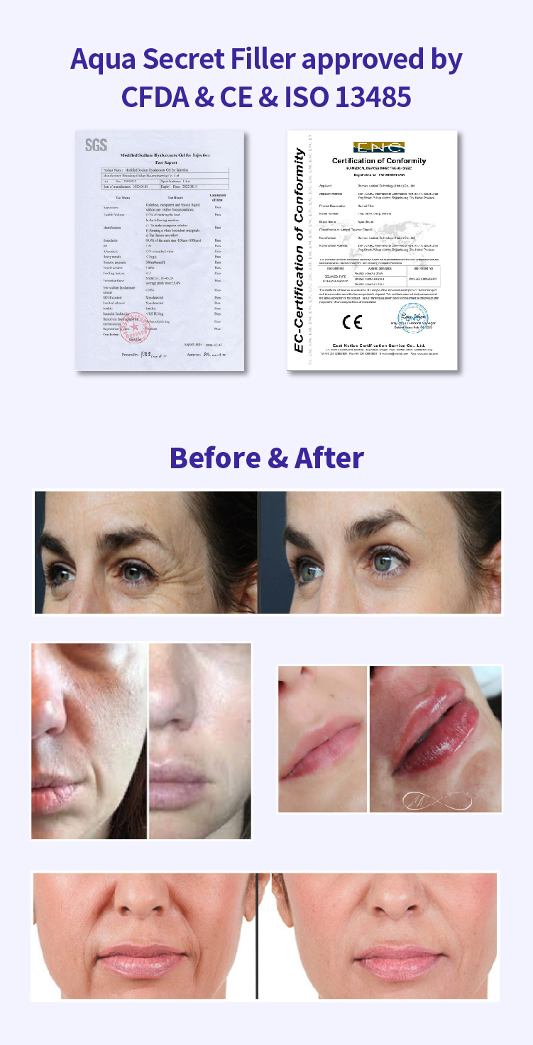 filler in lips before & after - Dermax